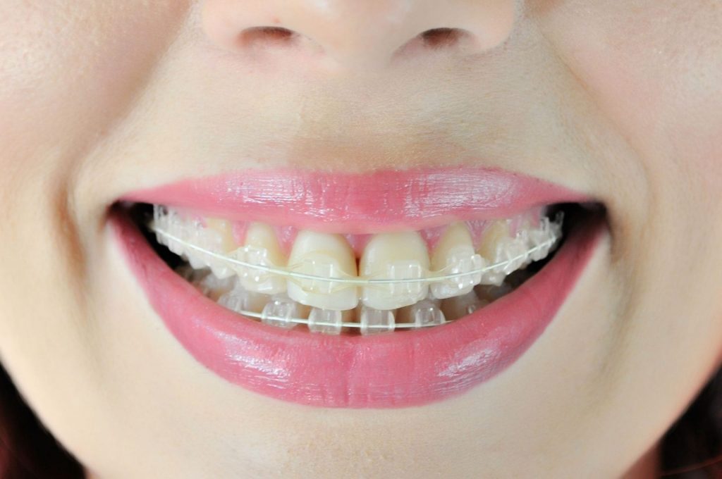 Types Of Braces Central Missouri Orthodontics