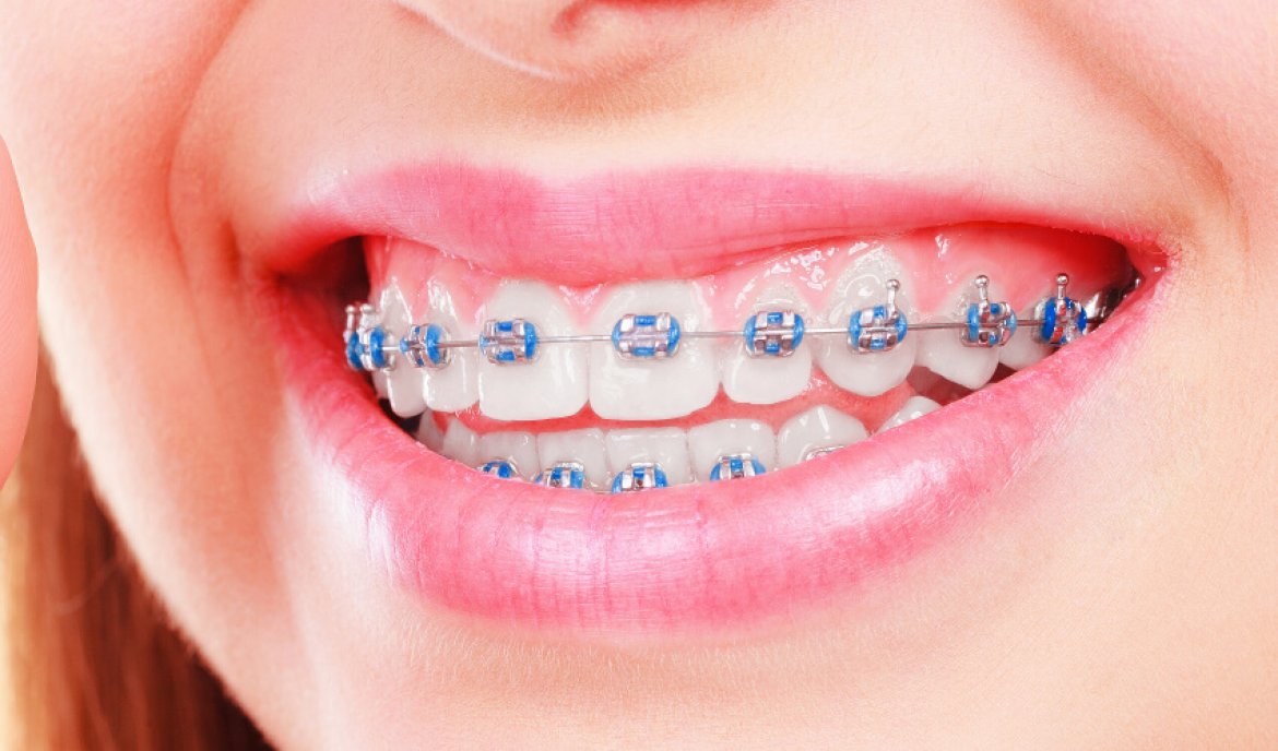 Types of Braces Central Missouri Orthodontics